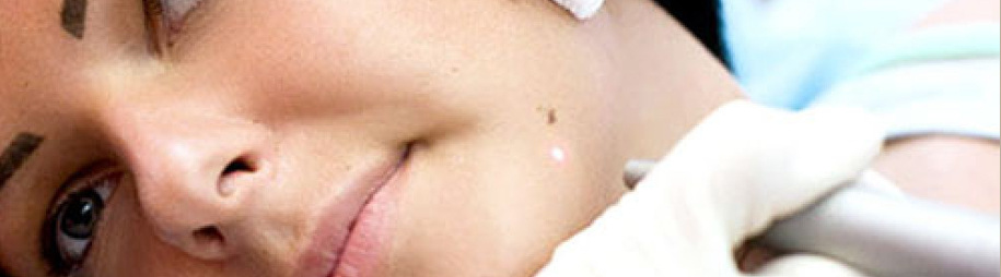 Moles-Warts-Skin Tags Removal