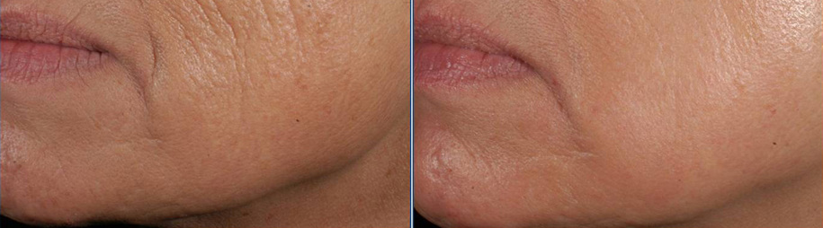 Skin resurfacing