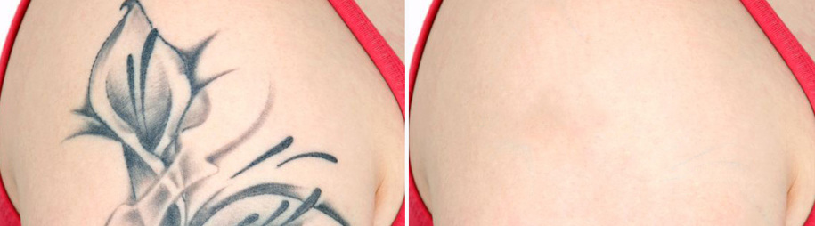 Tattoo & birthmark removal